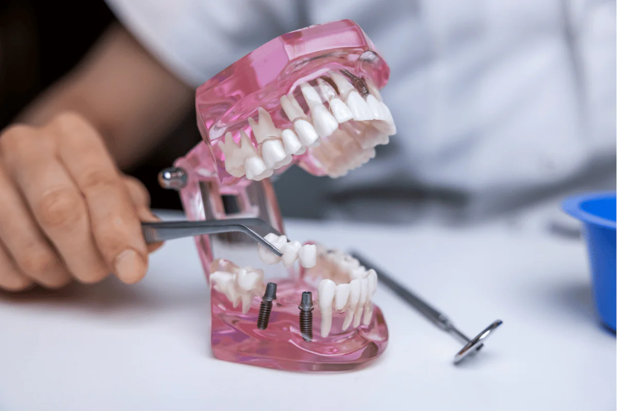 Dental Bridges in Lucknow