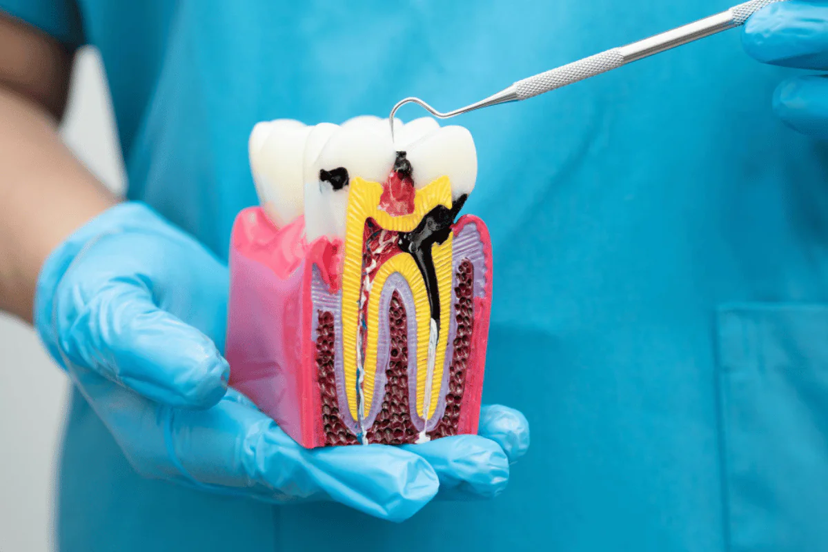 Root Canal Treatment in Lucknow