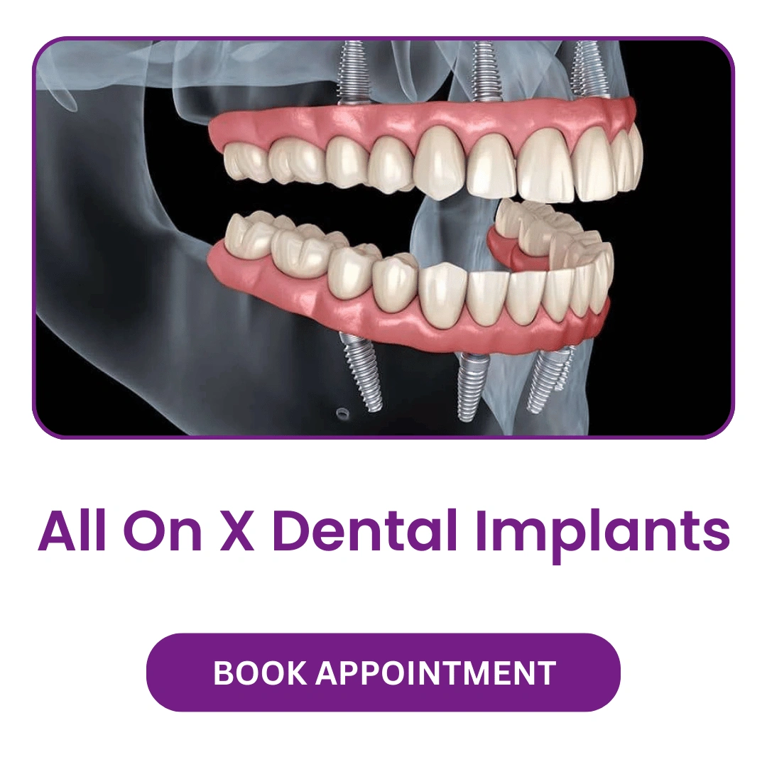 All On X Dental Implants