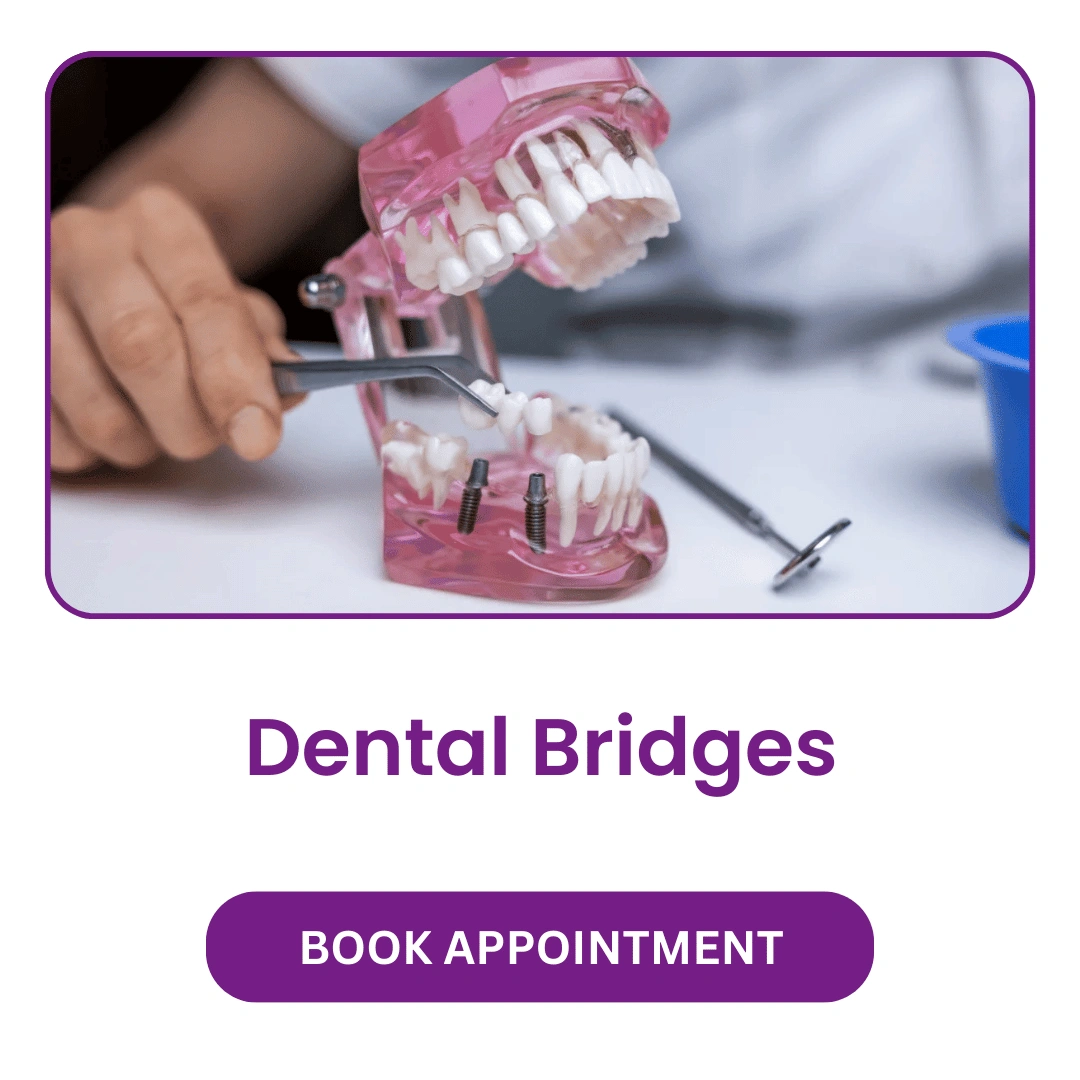 Dental Bridges