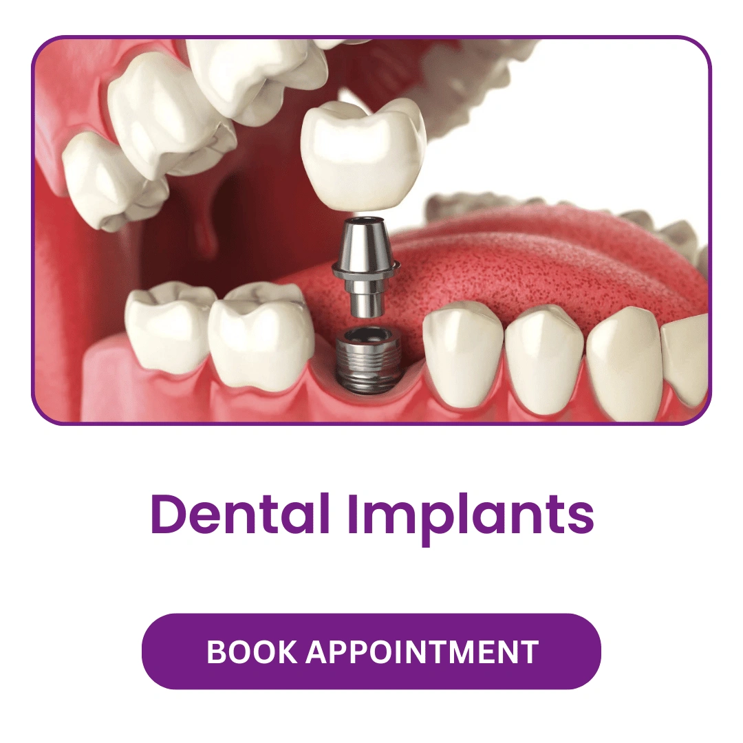 Dental Implants