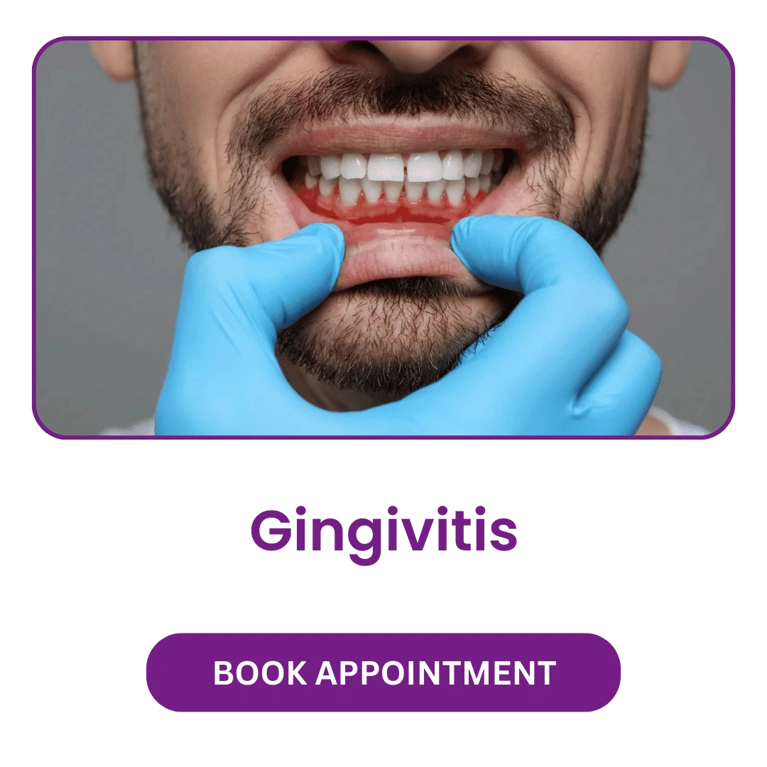 Gingivitis