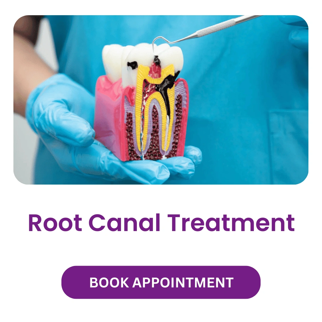Root Canal Treatment