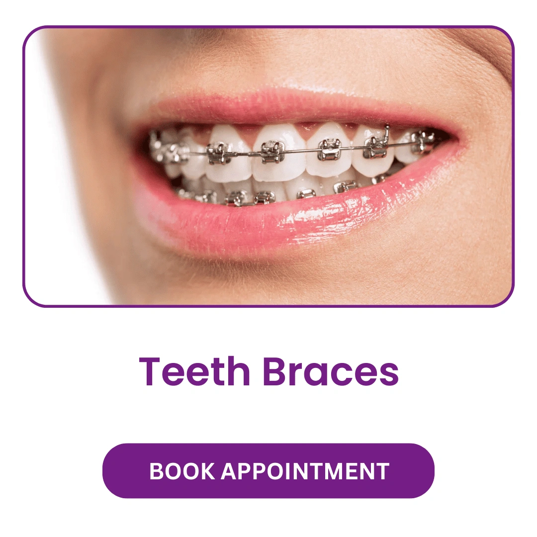 Teeth Braces