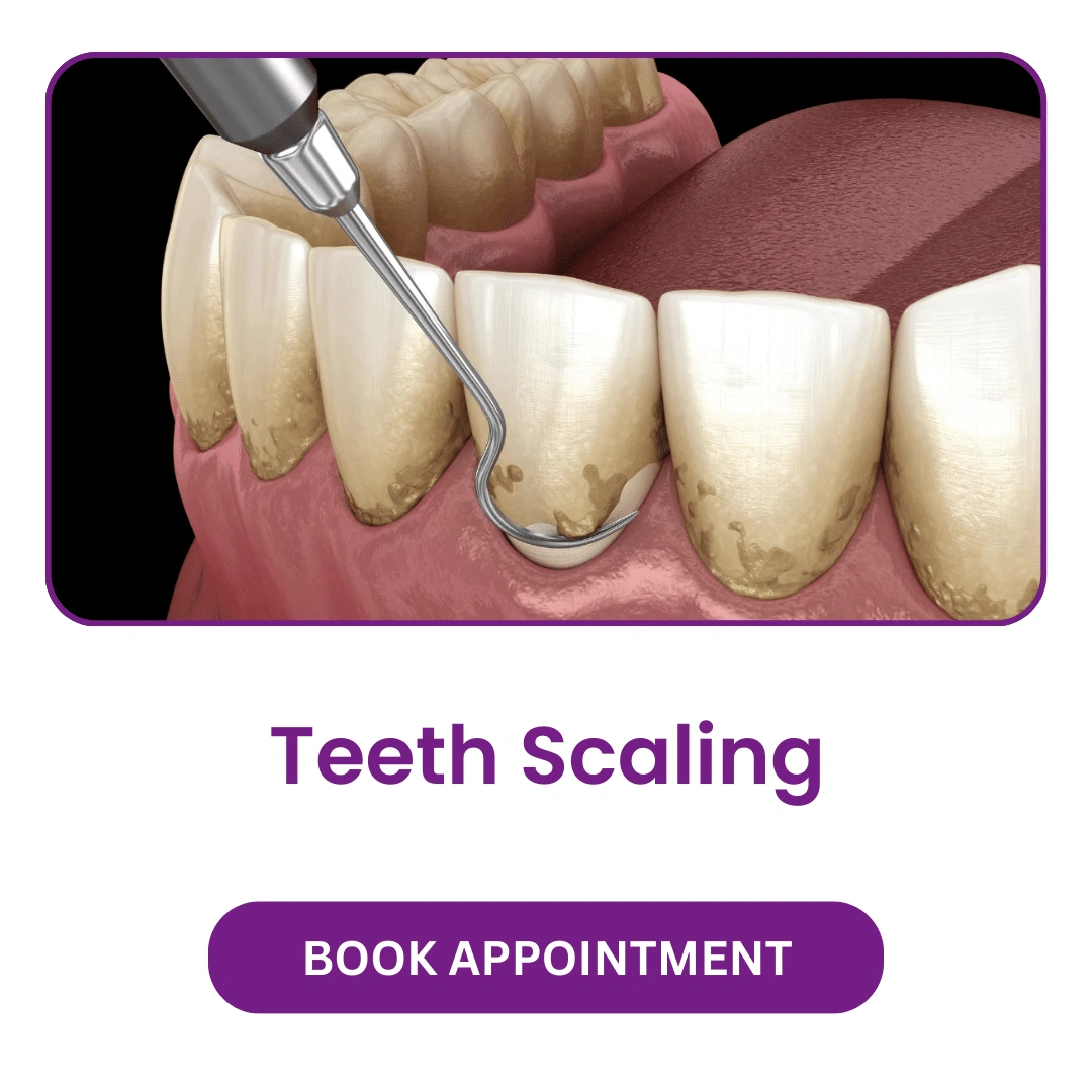 Teeth Scaling