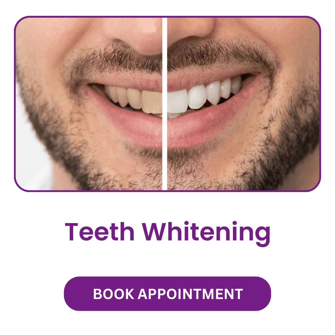 Teeth Whitening