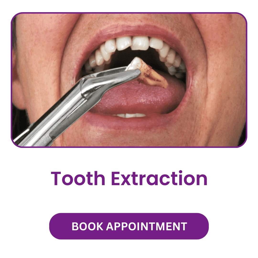 Tooth Extraction