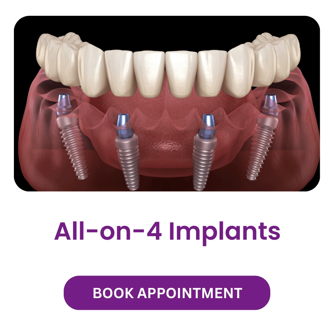 All-on-4 Implants