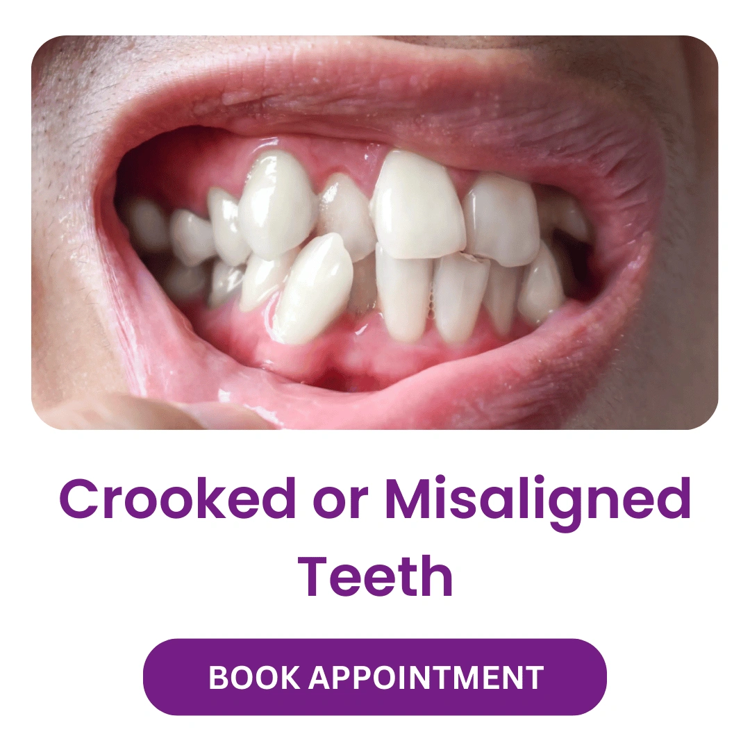 Crooked or Misaligned Teeth