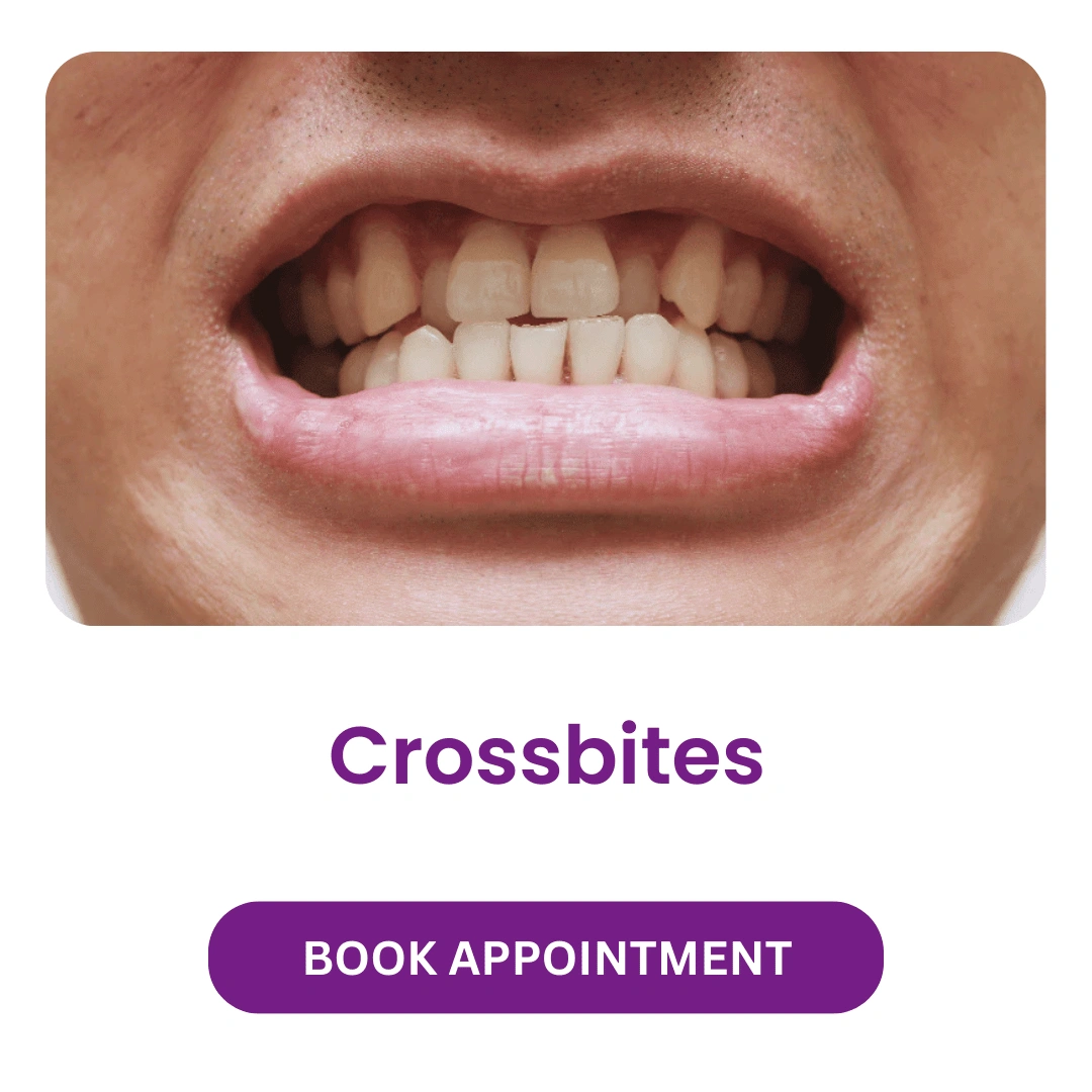 Crossbites