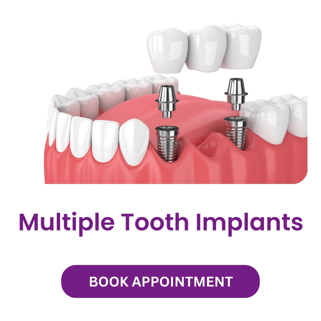 Multiple Tooth Implants