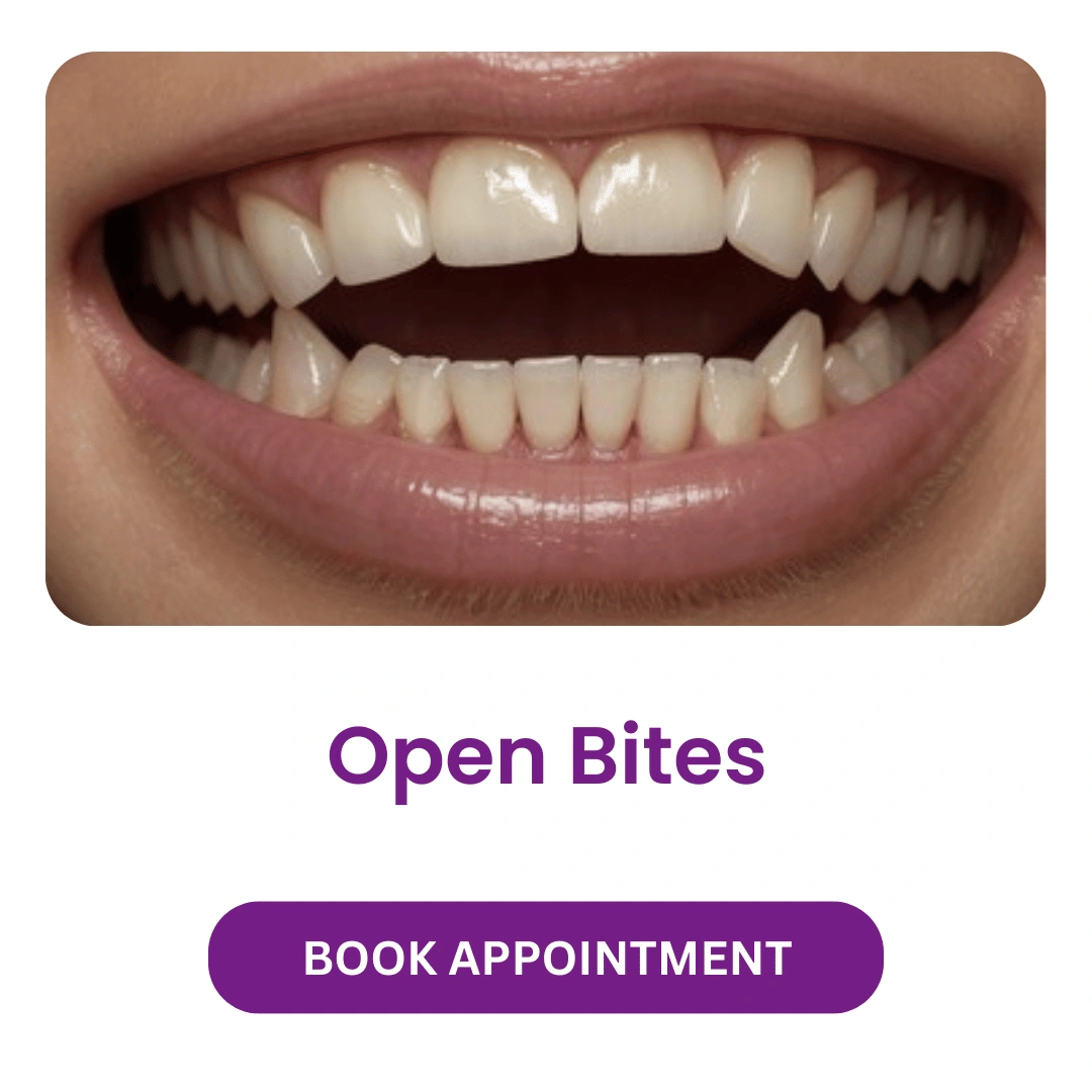 Open Bites