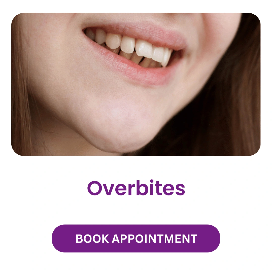 Overbites