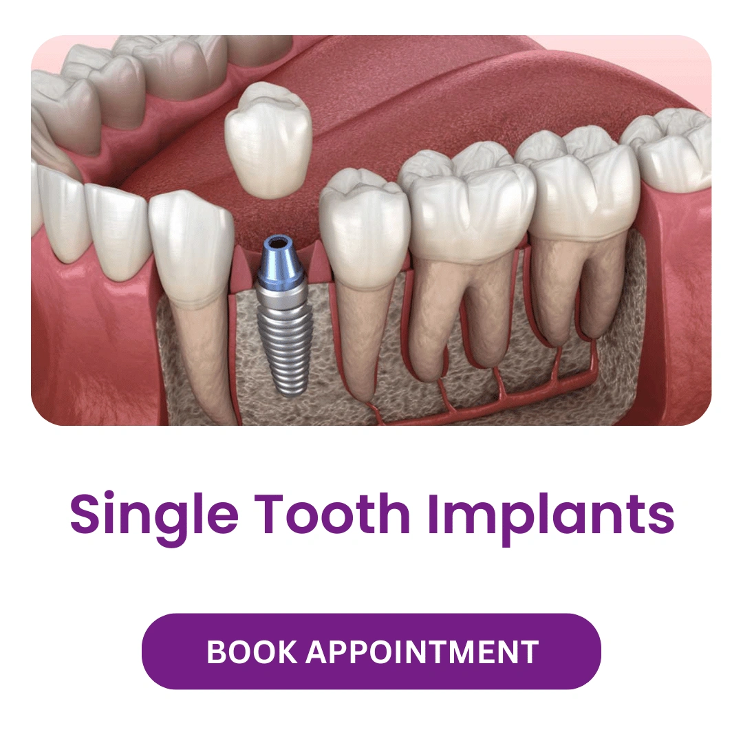 Single Tooth Implants