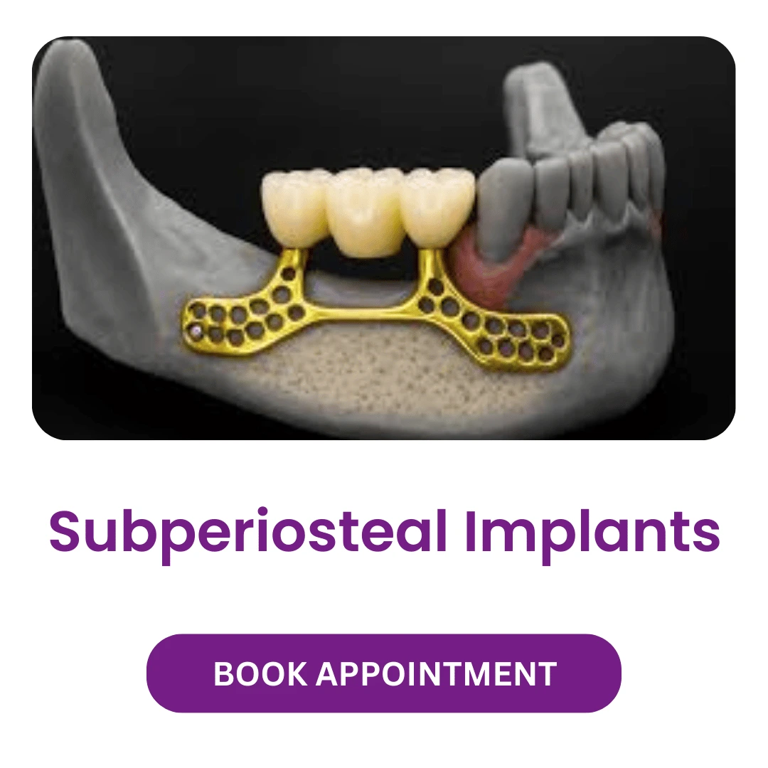 Subperiosteal Implants