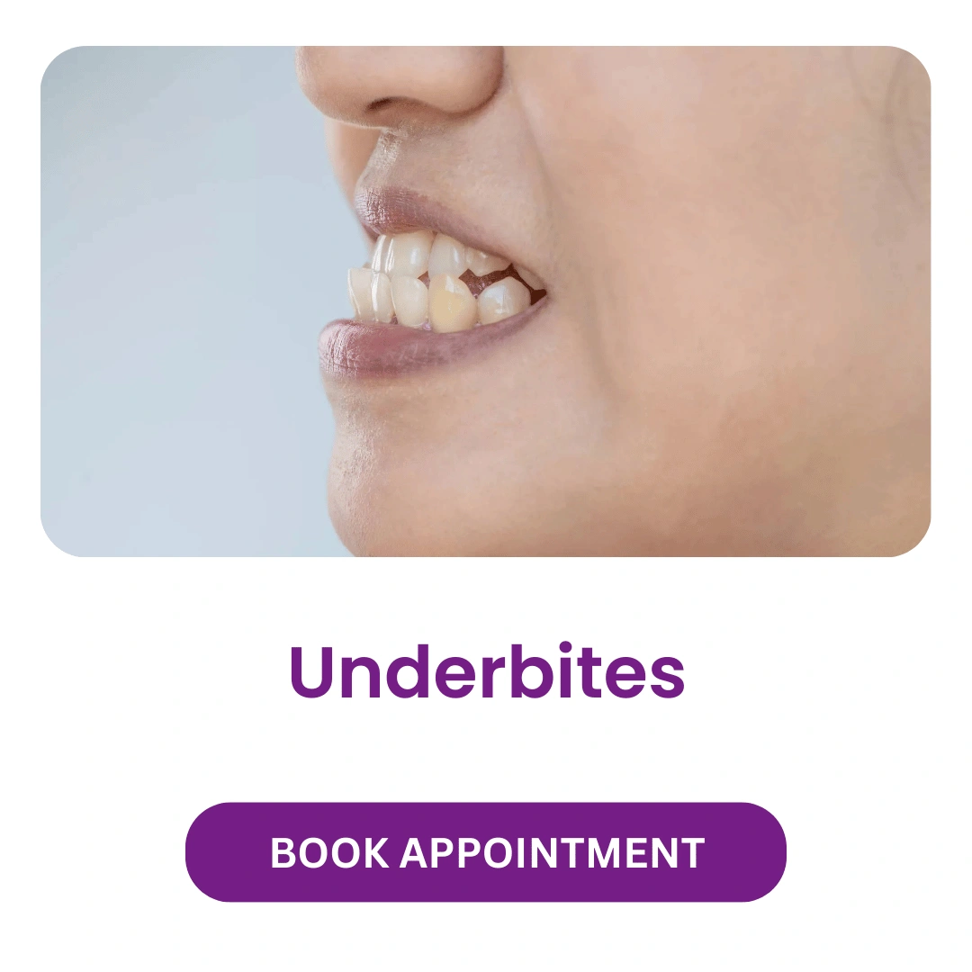 Underbites