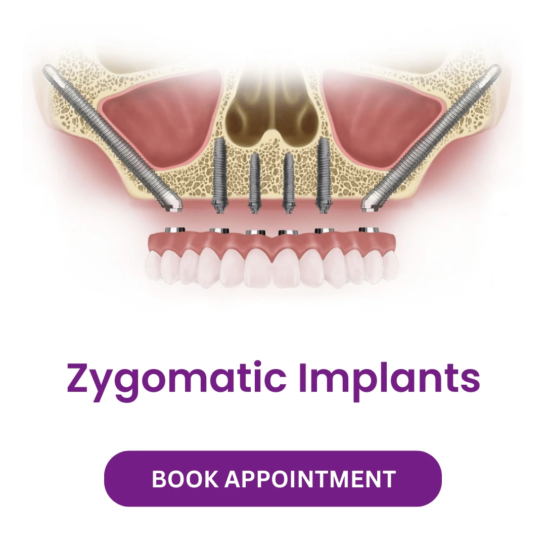 Zygomatic Implants