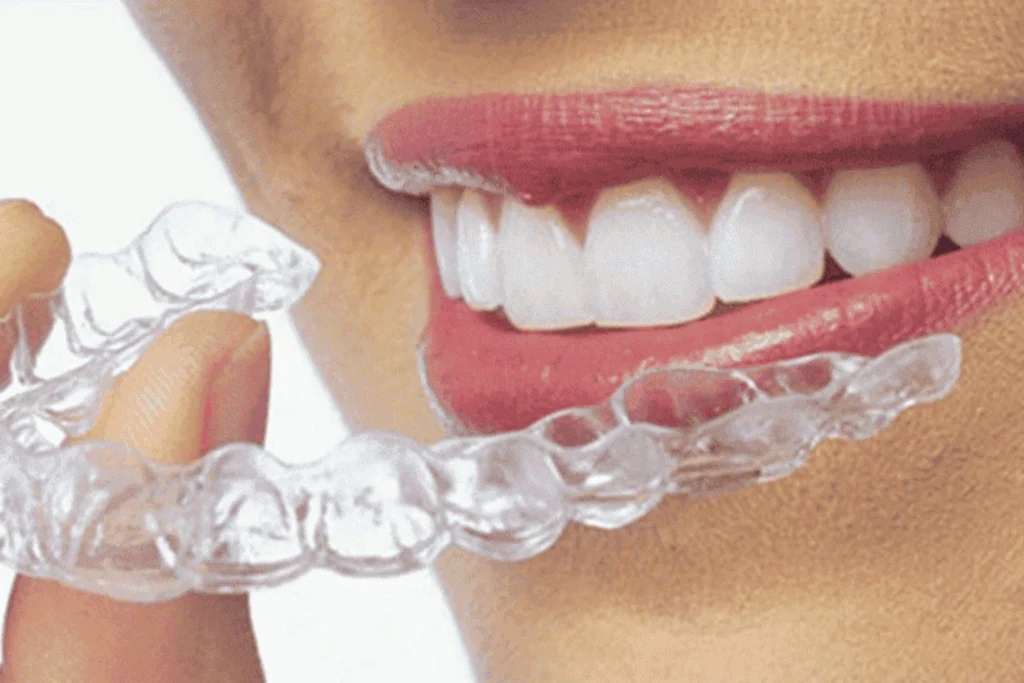 Clear Teeth Aligners in Lucknow