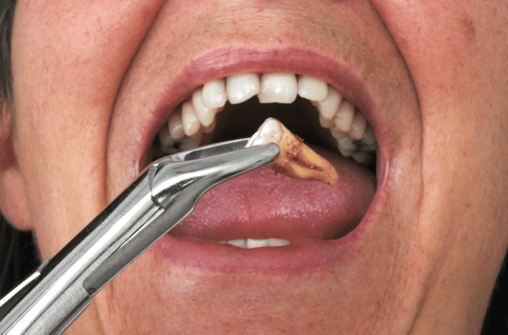 Tooth Extraction Tooth Extraction